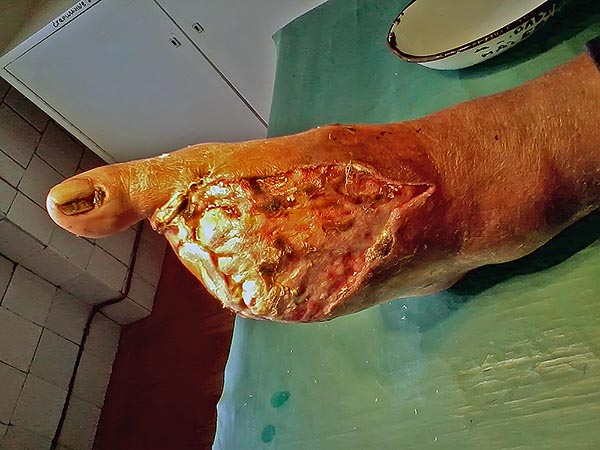 Диабетическая ангиопатия, диабетическая ангиопатия нижних конечностей, диабетическая ангиопатия сосудов нижних конечностей Диабетическая ангиопатия, диабетическая ангиопатия нижних конечностей, диабетическая ангиопатия сосудов нижних конечностей